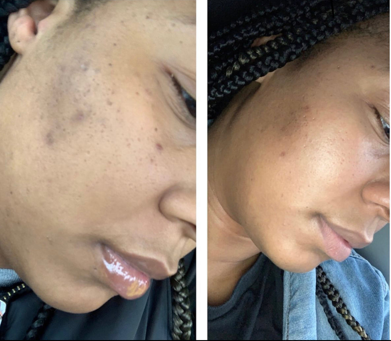 Hyperpigmentation Kit