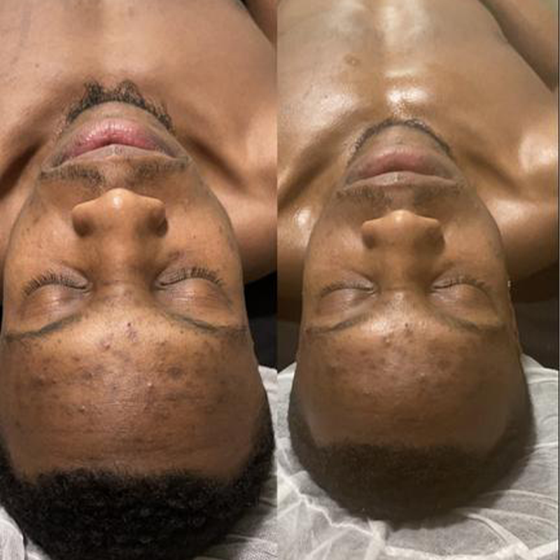 Hyperpigmentation Kit