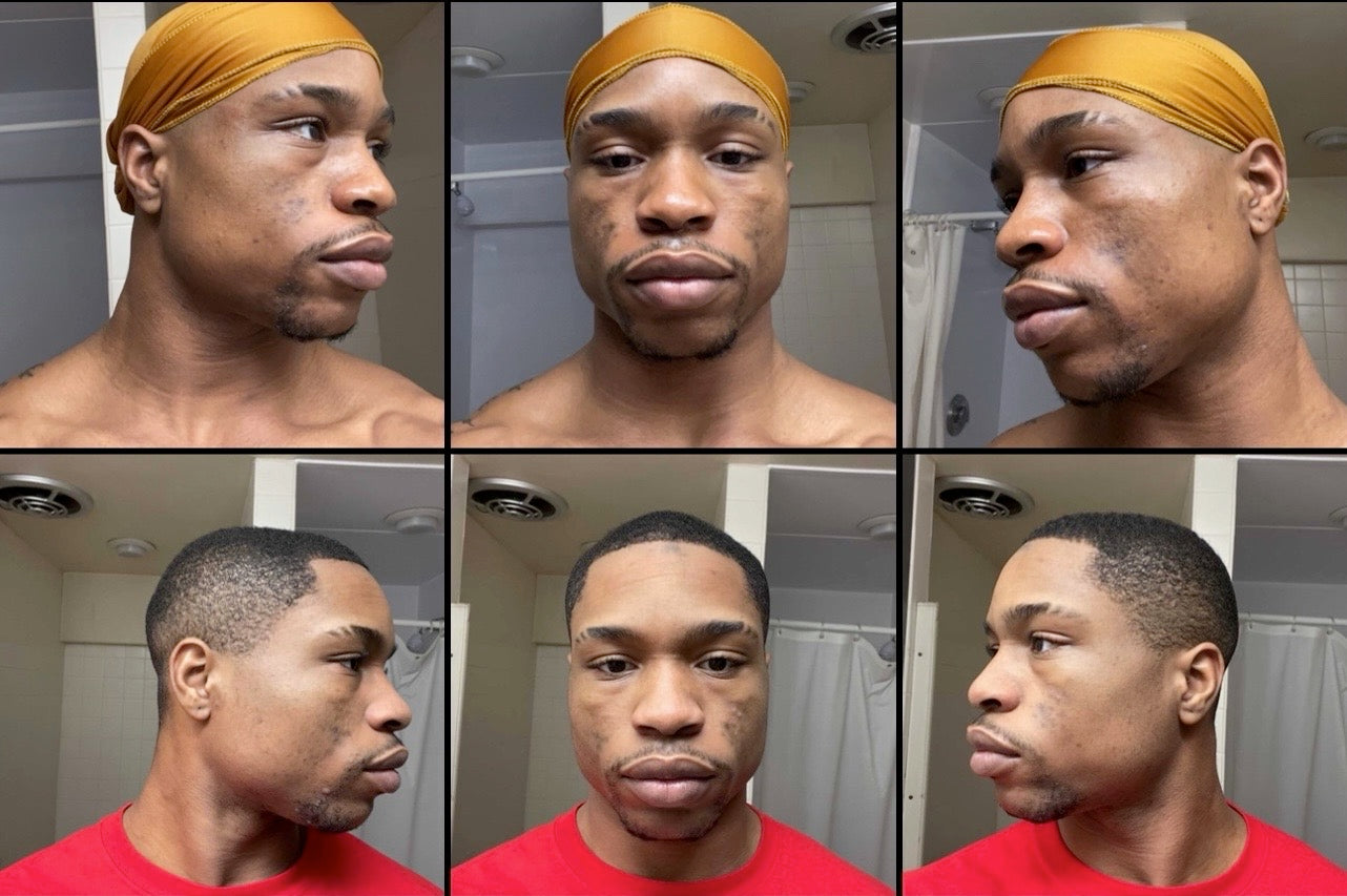 Acne Kit